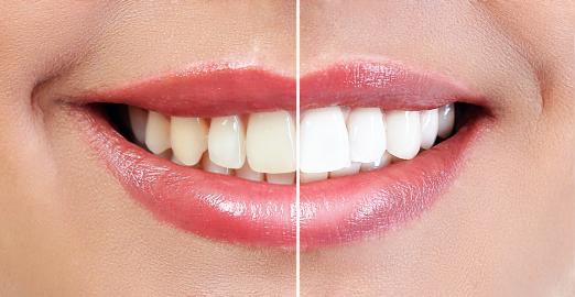 This Teeth Whitening Prewash May Leave You 6 Shades Lighter in 5 Days