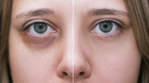 This Arnica Eye Cream Is the Ultimate Cure for Dark Circles