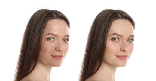Skin Detox! Renew Your Complexion With These Professional Resurfacing Pads