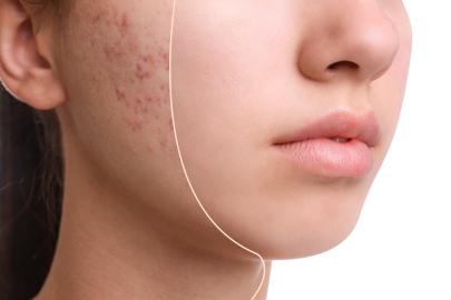 Banish Annoying Breakouts With This Viral Clay Mask
