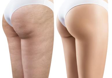 10 Best Butt and Thigh Cellulite Solutions for Real Results