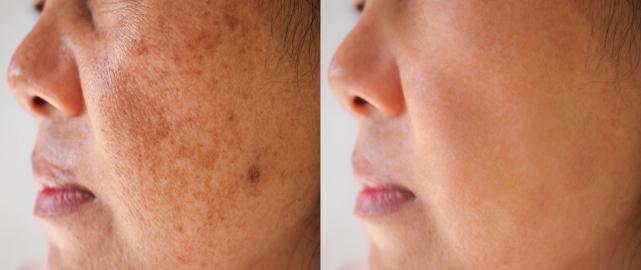 90% of Users Saw a Reduction in Their Dark Spots With This Serum