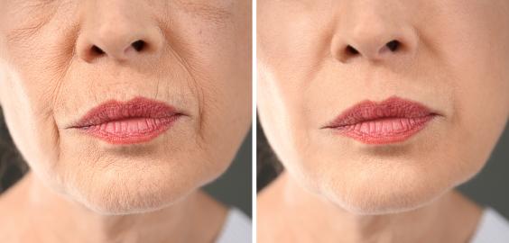 Hate the Fine Lines on Your Upper Lip? Try This Professional-Strength Serum