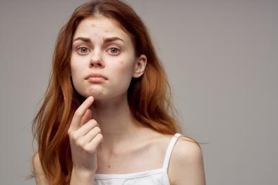 13 Best Acne Spot Treatments to Dramatically Improve Pimples Overnight