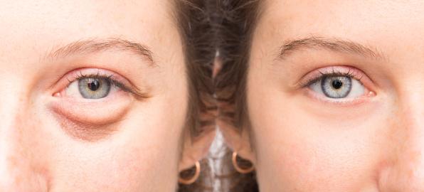 This Rapid Bag Reducer Is Like a ‘Temporary Eye Lift in a Tube’