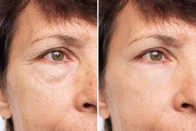 This Eye Cream May Get Rid of Puffiness and Wrinkles in Just 15 Minutes