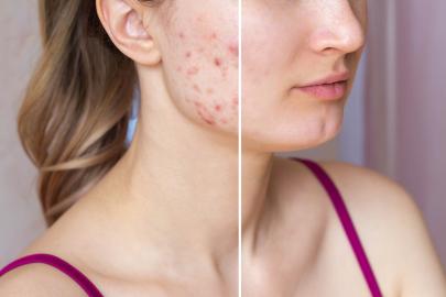 Tackle Adult Acne in 1 Week With This Medicated Gel Serum 
