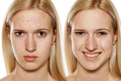 11 Affordable and Popular Acne Treatments on Amazon