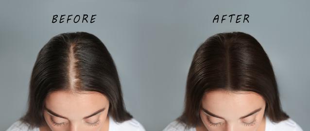Restore Your Hairline, Part or Bald Spots in Seconds With This Product