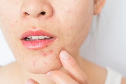 This Lactic Acid Serum Dramatically Helped Fade My Hormonal Acne Scars