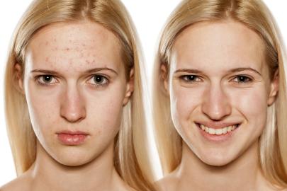 13 Best Hormonal Acne Treatments for Reducing Inflammation and Irritation