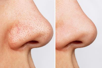 These Easy-to-Use Pads Shrink the Appearance of Pores 'In a Week' 